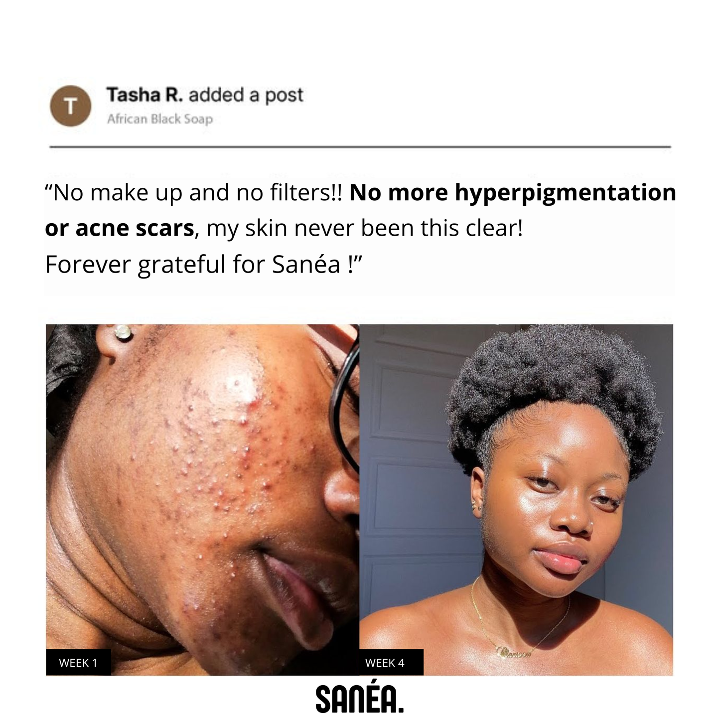 Anti-Acne & Dark Spots African Soap